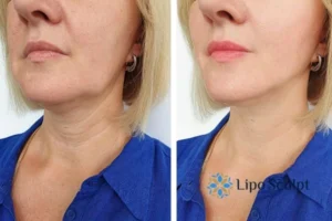 Double chin before and after Hi-Fu treatment 4 Book your double chin treatment Ashby Magna today! We are here to help!