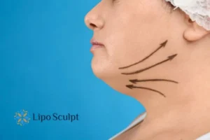 Double chin before and after Hi-Fu treatment 3 Boost your confidence with a Double chin treatment Ashby Magna