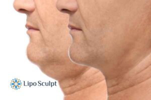 Double chin before and after Hi-Fu treatment 2 Double chin treatment Ashby Magna from Lipo Sculpt - feel more confident today!
