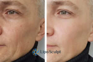 How to Fight Aging Symptoms 3 Fight Aging Symptoms Ashby Magna With HIFU and Morpheus8 Today!
