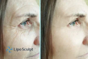 How to Fight Aging Symptoms 2 Do you want to Fight Aging Symptoms Ashby Magna? Contact Lipo Sculpt today!