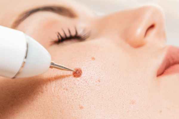 CryoPen: 5 Skin Concerns It May Be Used to Treat 3 What actually happens during a CryoPen treatment Ashby Magna?