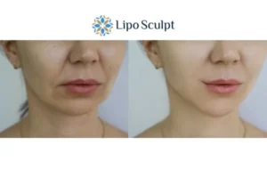 Explaining Total Skin Tightening Treatment And What It Can Do For You 2 Do you want to boost your self confidence? Give Morpheus8 Ashby Magna a try today!
