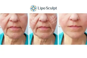 Explaining Total Skin Tightening Treatment And What It Can Do For You 3 Boost your confidence with Morpheus8 Ashby Magna call our team today!