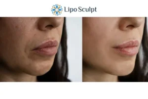 Explaining Total Skin Tightening Treatment And What It Can Do For You 4 Morpheus8 Ashby Magna the best results - call our team today!
