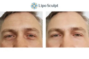 Explaining Total Skin Tightening Treatment And What It Can Do For You 6 Morpheus8 Ashby Magna book in today to find out more!