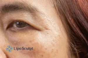 Cryopen: The Revolutionary Treatment for Age Spots Unveiled 2 Are age spots Ashby Magna giving you low self esteem? Contact us today!