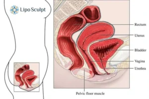 Treatment For A Leaky Bladder 2 How EM Chair treatment Ashby Magna can help Leaky bladder issues. Read more now!