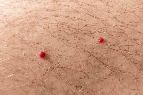 CryoPen: 5 Skin Concerns It May Be Used to Treat 2 cherry angioma removal Ashby Magna