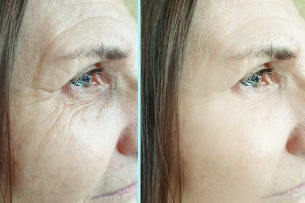 Why Do People Choose HIFU for a Non-Surgical Facelift? 4 How long can HIFU results last Ashby Magna?