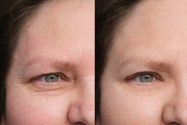 HIFU vs Botulinum Toxin: Understanding the Differences 4 How long do HIFU results last Ashby Magna?