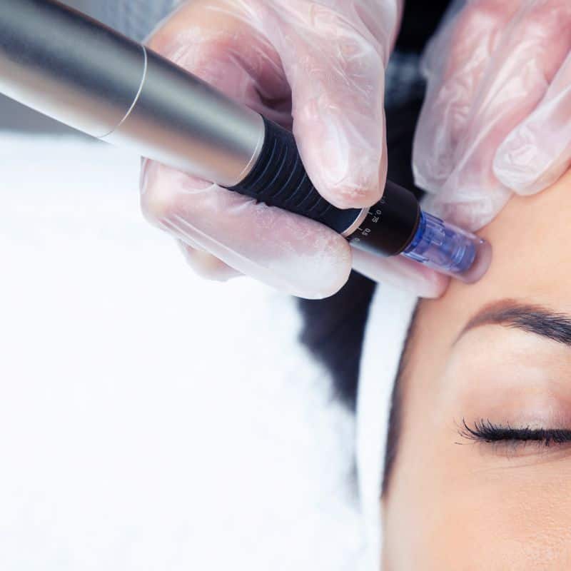 Morpheus8 treatment Ashby Magna from Lipo Sculpt - Book in today!