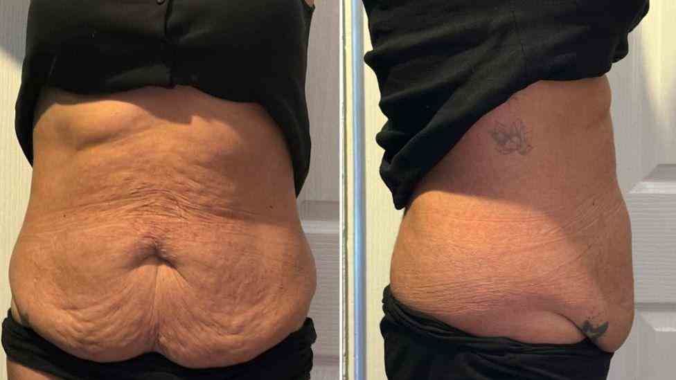 Lost the Weight but Not the Loose Skin? What You Should Know 1 Is It Definitely Loose Skin Ashby Magna?